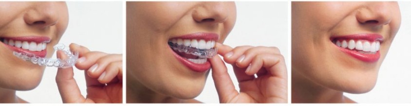 Three-panel image showing a person holding, inserting, and wearing an Invisalign aligner, with a close-up of their smiling mouth in each panel, illustrating how teeth can be straightened evenly.